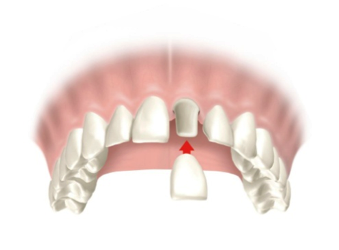 Prótesis Dental | Clínica Broch Dental